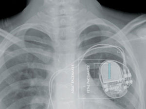 Pacemaker convenzionale e fetale a confronto