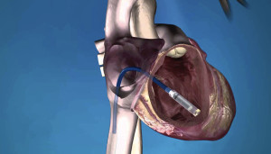 Micra Transcatheter Pacing System (TSP)