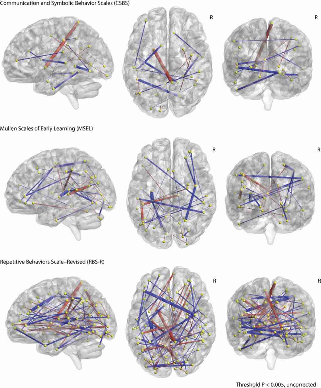 Tratti distintivi nelle scansioni cerebrali che hanno permesso la previsione dell'autismo nei bambini 