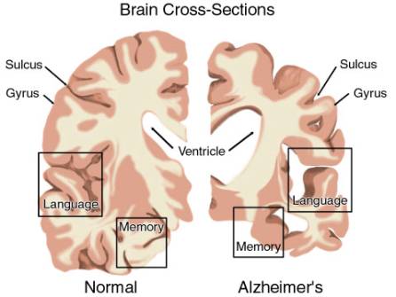 Studiare l'Alzheimer con la criomicroscopia elettronica
