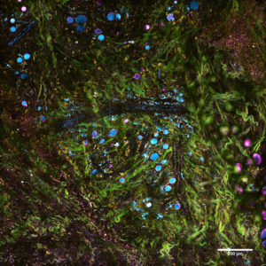 Nuova tecnica di imaging tissutale per mappare la progressione dei tumori