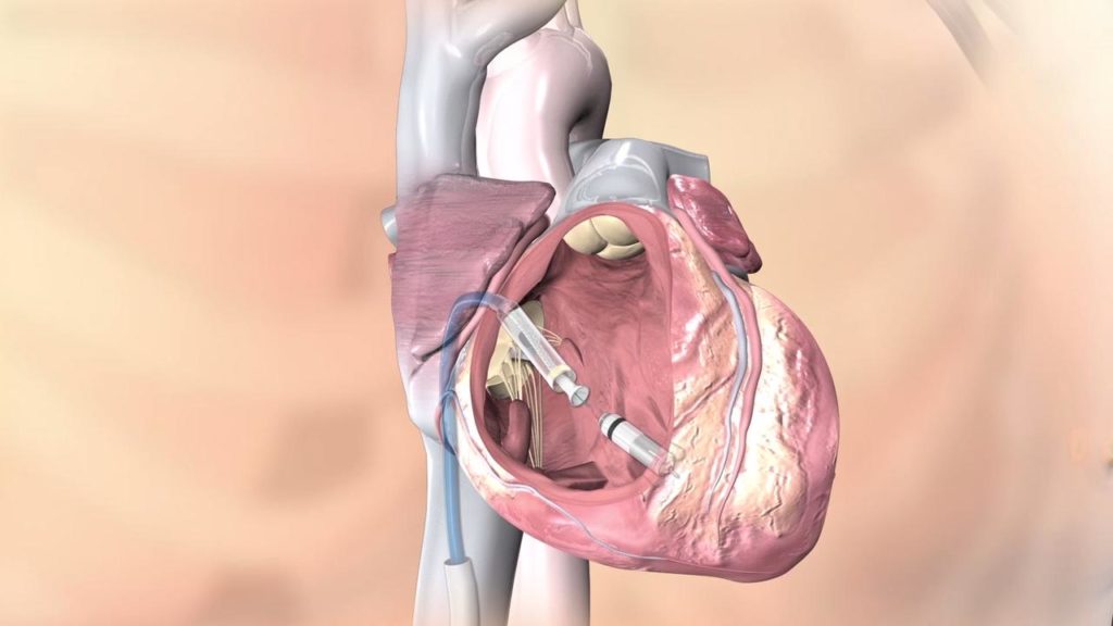 MIcra TPS:il pacemaker senza fili più piccolo al mondo