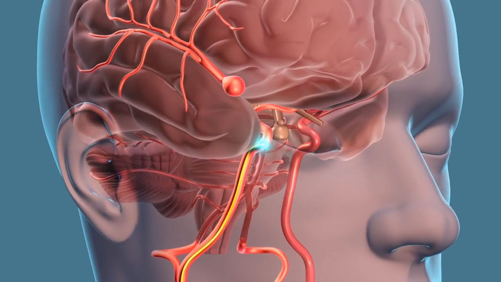 Monitoraggio wireless di aneurismi intracranici grazie ad un nanosensore integrato nello stent flow-diverter