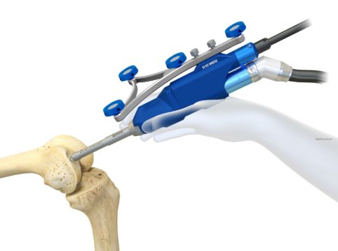 Napoli: primo intervento di chirurgia robotica ortopedica in Campania