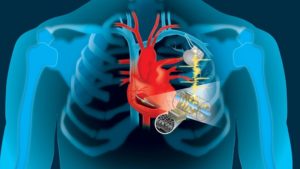 Alimentare i pacemaker con i battiti del cuore: una soluzione possibile