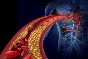 Aterosclerosi: quanto rischiamo? Ce lo dice la legge di Poiseuille