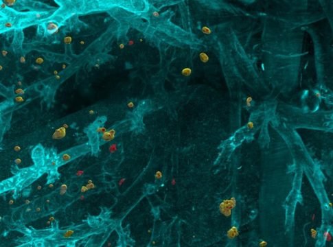Grazie all’intelligenza artificiale sarà possibile rilevare le metastasi invisibili