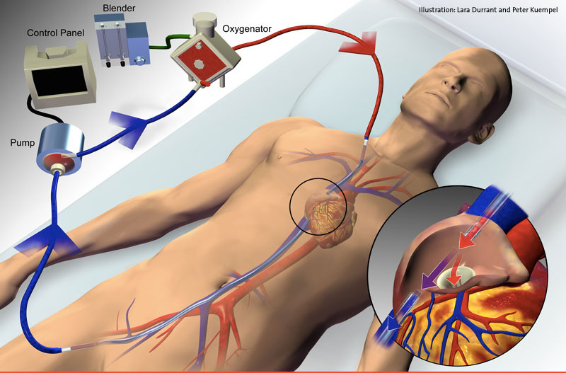 Schematizzazione circuito di ECMO, utilizzato per riscaldare la temperatura della paziente arrivata in arresto cardiaco a causa dell'ipotermia.
Credits: pazienti.it