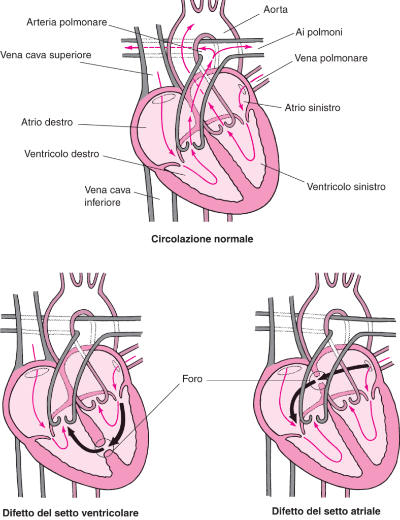 canale atrioventricolare completo cuore malformazione congenita genova 