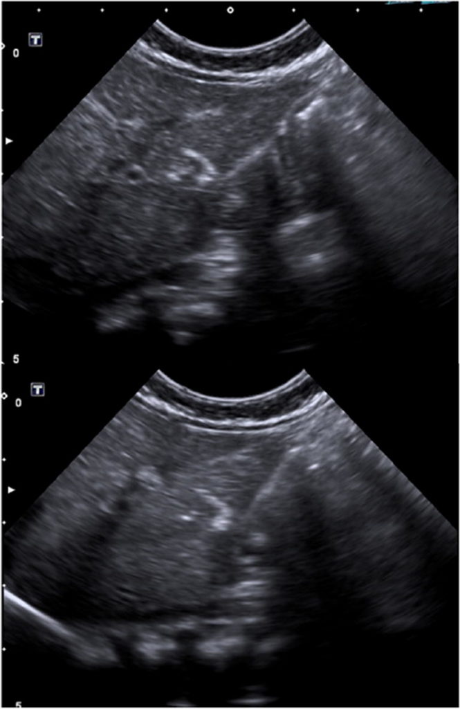 cellule staminali epatiche torino bambini fegato ecografia sonda ultrasuoni