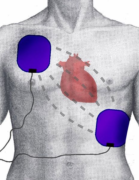 defibrillatore indossabile morte cardiaca improvvisa