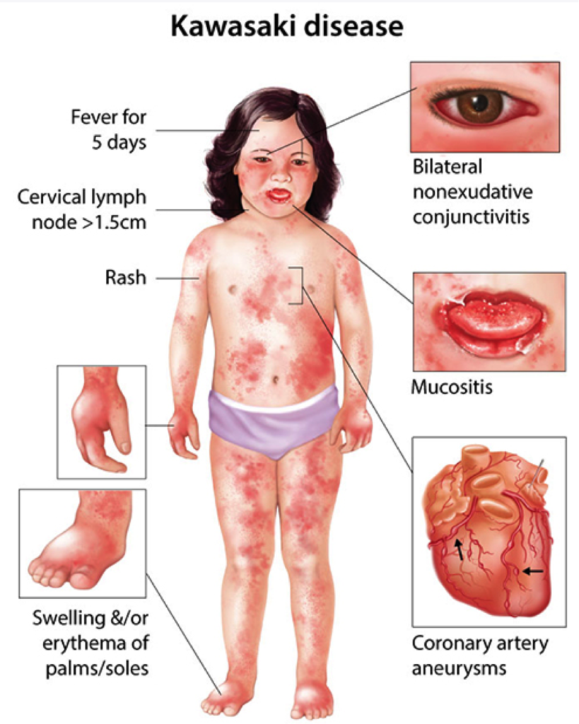 malattia di Kawasaki covid19 coronavirus italia bambini 