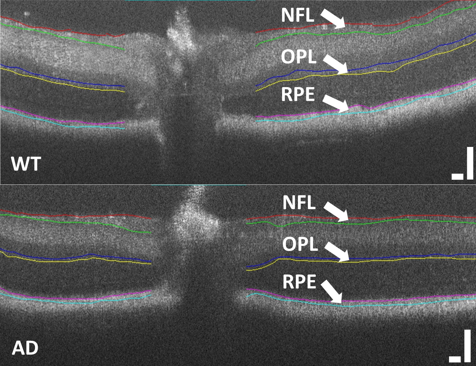 Biomarcatori retinici per la diagnosi precoce della malattia di Alzheimer. Credits: Scientific Reports