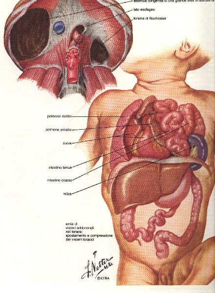feto chirurgia fetale ernia diaframmatica congenita Italia malattia intervento fetoscopia 