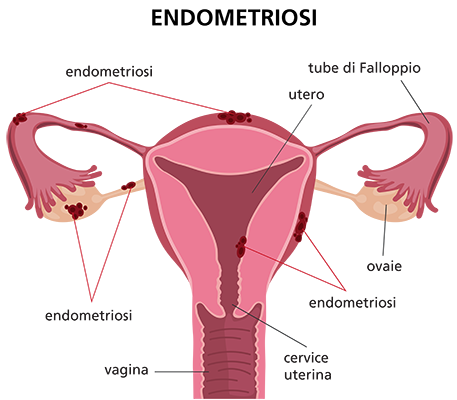 Endometriosi: la malattia cronica di cui soffre Rossella Brescia.