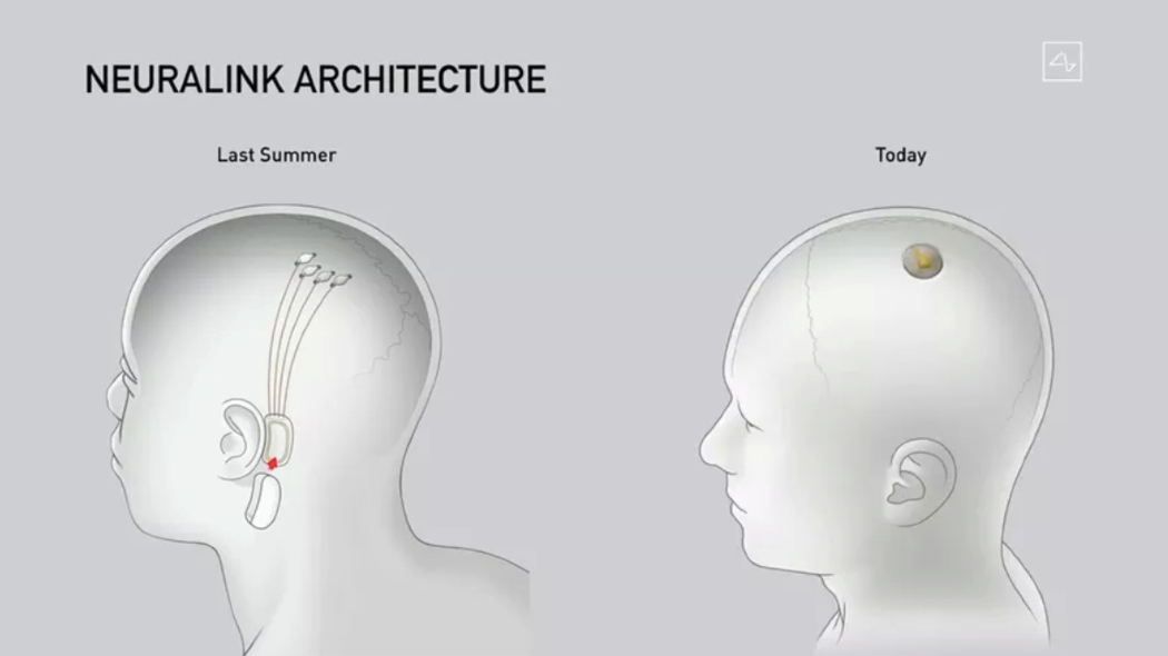 Elon Musk ha presentato i progressi del chip rivoluzionario di Neuralink. Credits: Neuralink