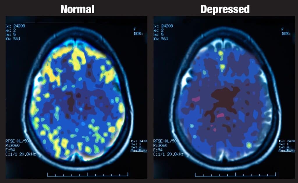 Le differenze nelle cellule cerebrali delle persone con depressione. Credits: Mark George, NIMH 1993