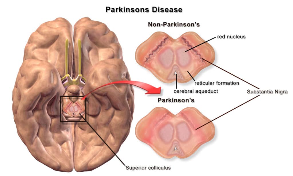 Parkinson Disease