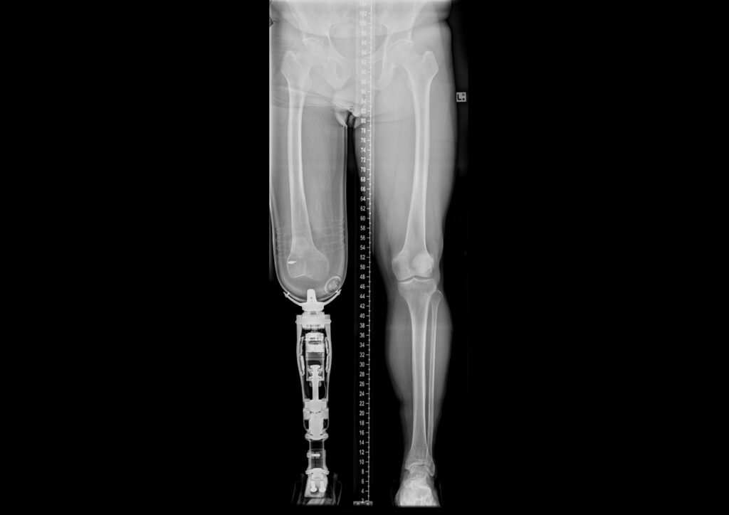 Protesi osteointegrate: quando l'arto artificiale è impiantato nell'osso. Credits: Case courtesy of Assoc Prof Frank Gaillard, Radiopaedia.org, rID: 32534