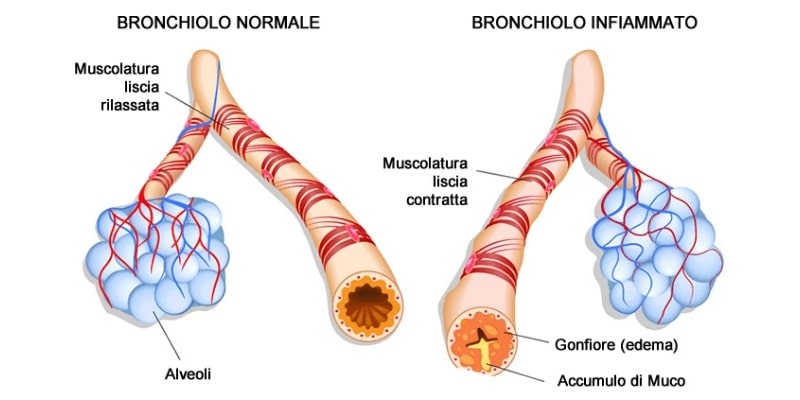 Asma Bronchiale
