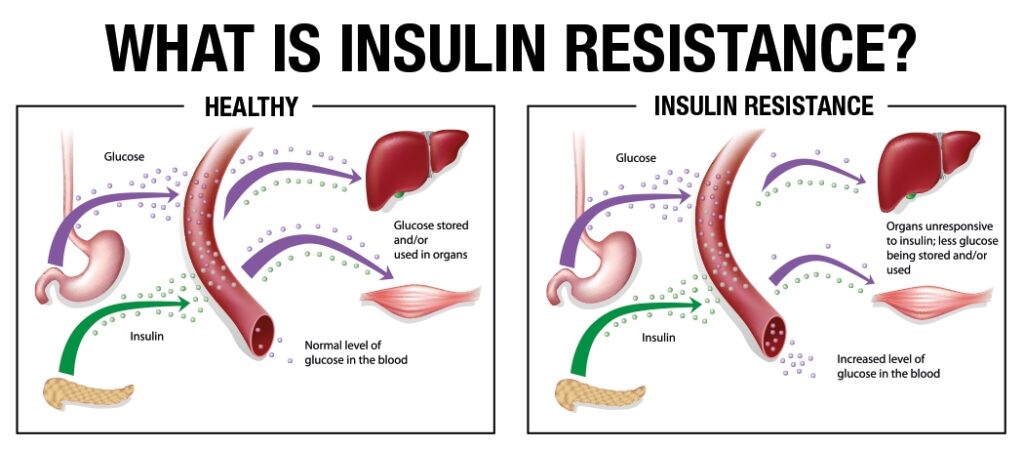 insulino resistenza glucosio diabete pancreas sangue cellule valentina ferragni