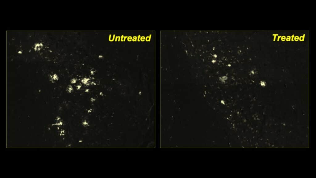 Nuovo farmaco per l'Alzheimer