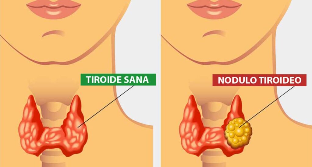 Tiroide: fisiologia, patologia e trattamenti dei disturbi. Credits: Igea S. Antimo