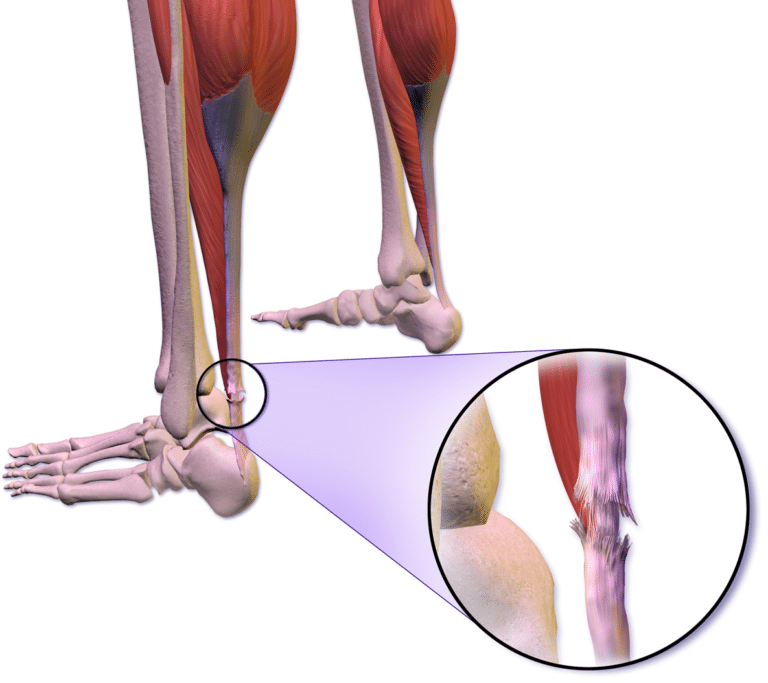 Ricostruzione del tendine d’Achille dopo infortunio: come funziona?