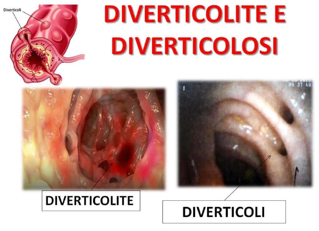 stenosi diverticolare colon papa francesco