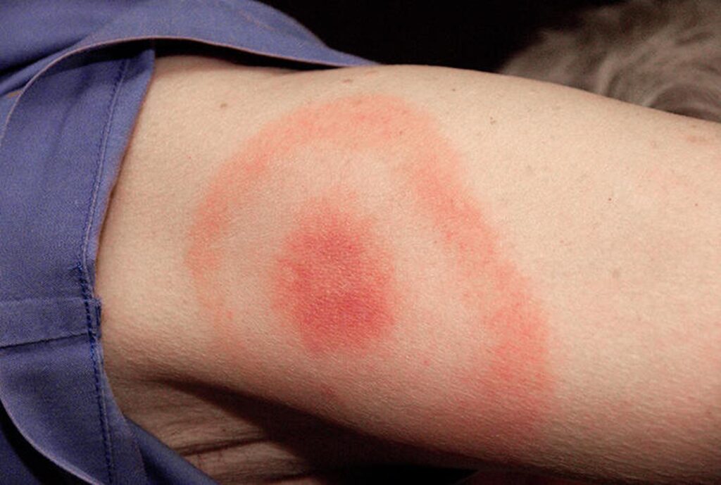 Malattia di Lyme: una nuova cura potrebbe portare alla sua eradicazione