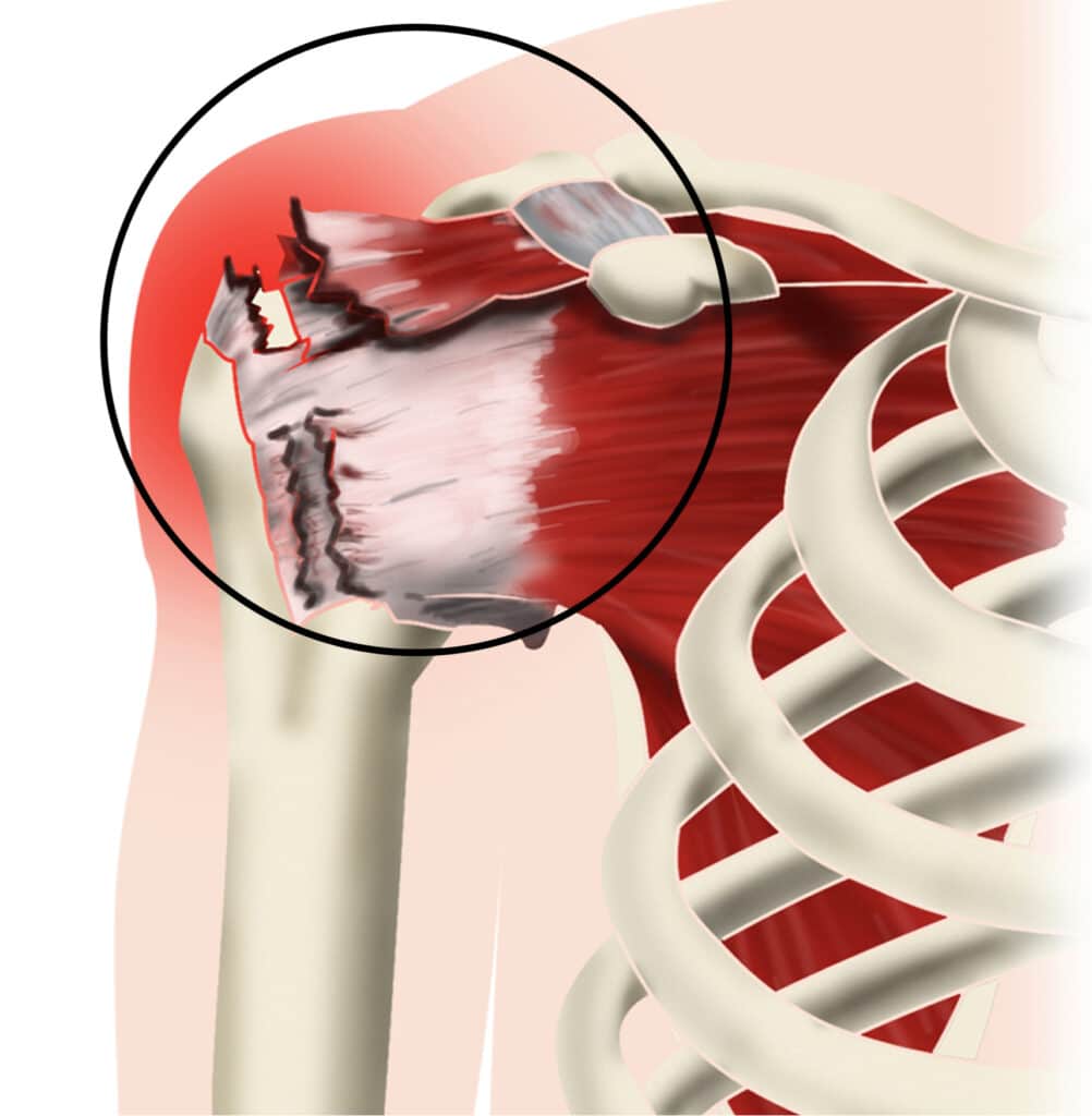 Lesioni della cuffia dei rotatori: un palloncino toglie il dolore e allontana la protesi