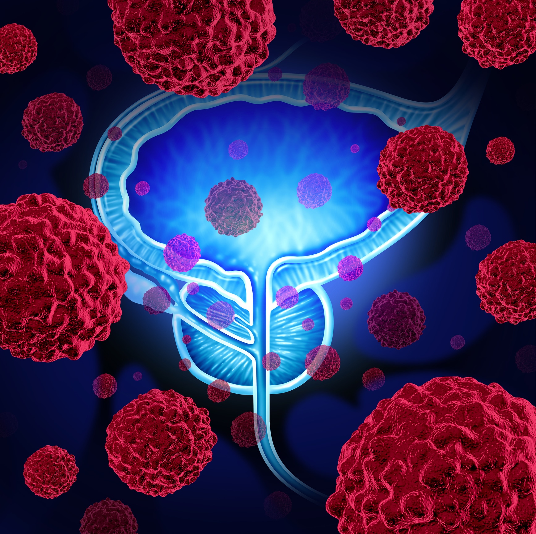Tumore della prostata: innovazione tecnologica e nuova pratica clinica
