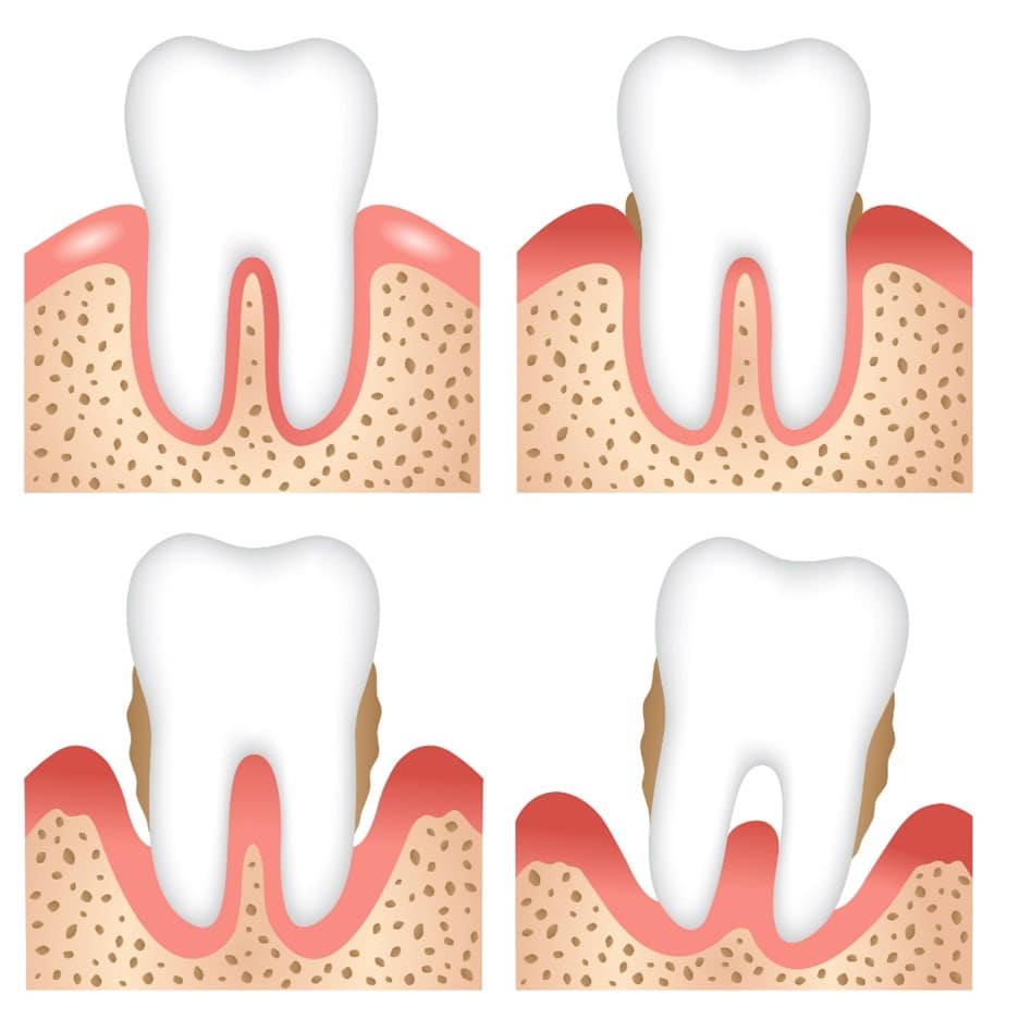 Le diverse fasi di progressione della parodontite – Credits: Centri dentistici PRIMO