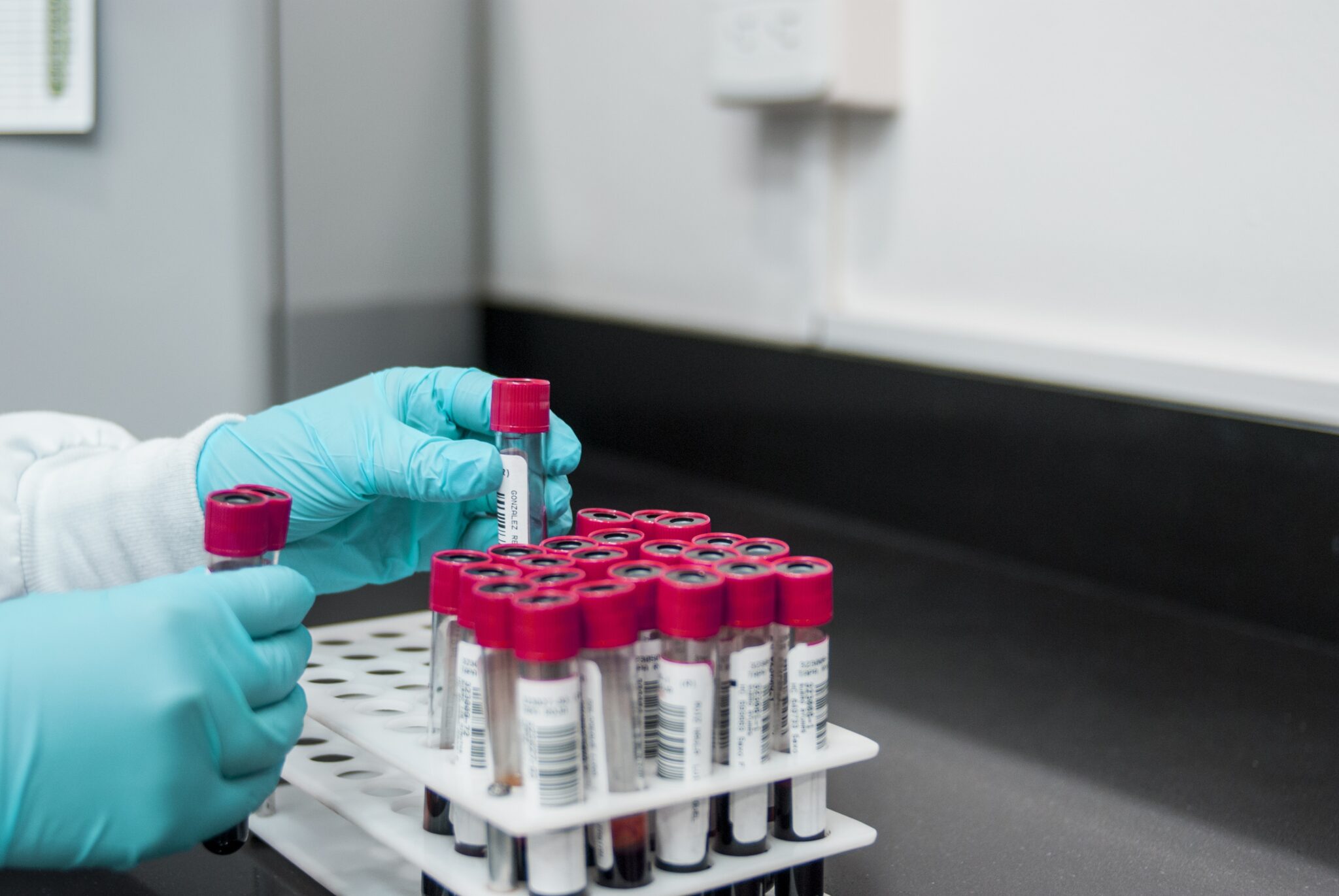 HPV e tumore orofaringeo: un esame del sangue può predire una recidiva