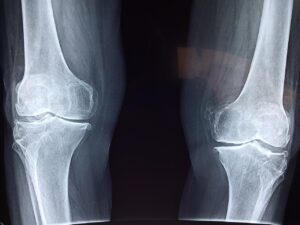 Osteoporosi kisspeptina