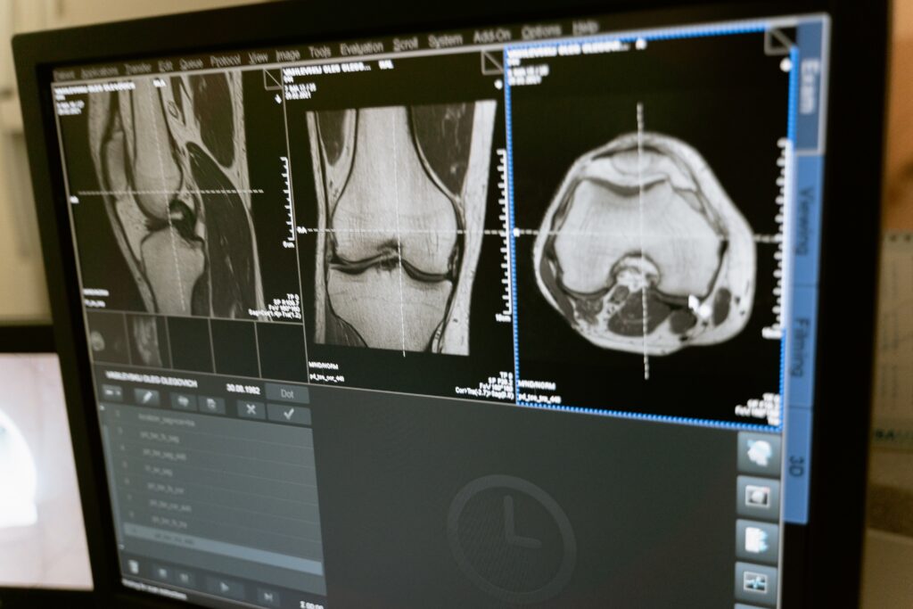 Osteoartrite hydrogel