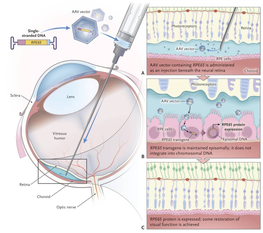 distrofie retiniche