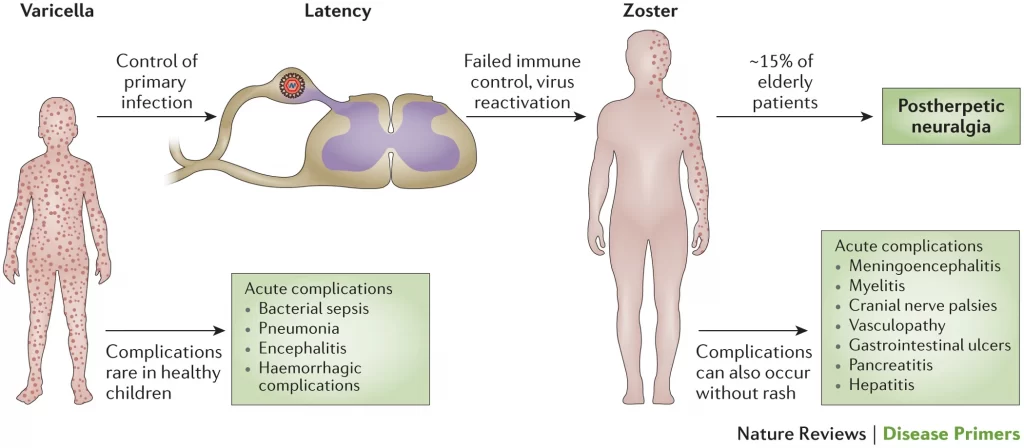 Herpes Zoster infezione primaria- latenza 