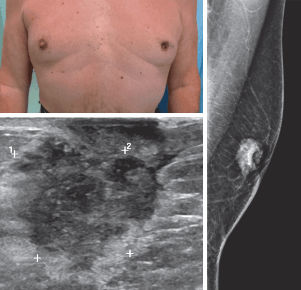 Immagini radiologiche di un tumore al seno maschile. Credits: Radiological features of male breast disease, our experience: pictorial essay, 2022