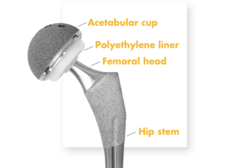 Sostituzione totale dell'anca