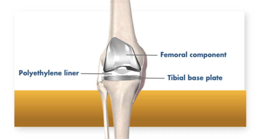 Sostituzione totale del ginocchio
