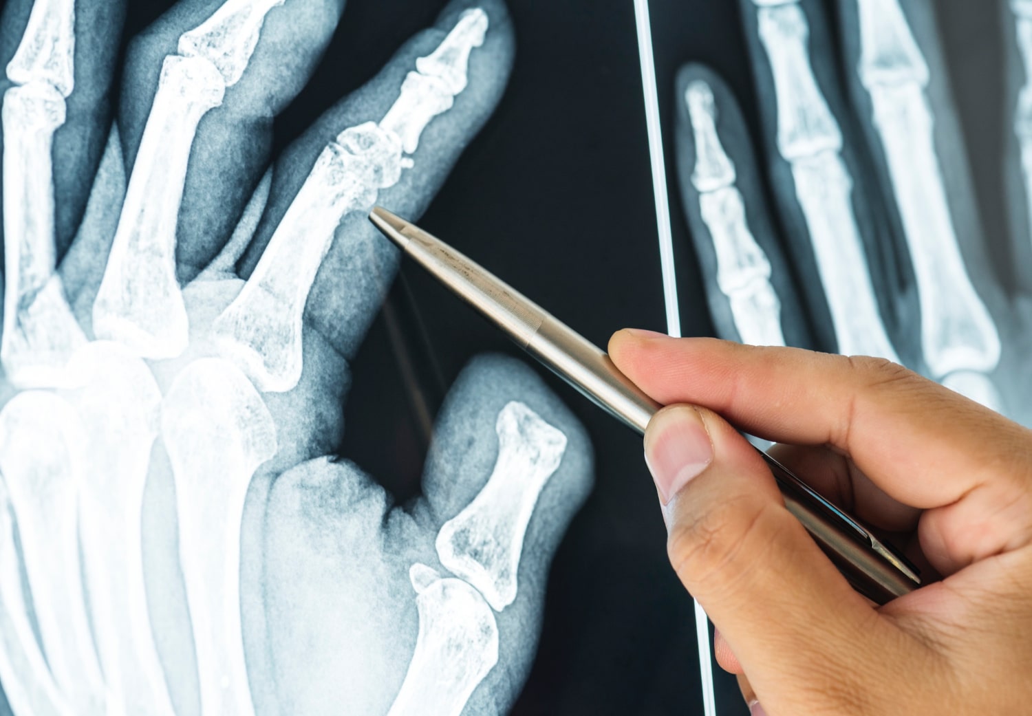 raggi x ai mano dita artrite
