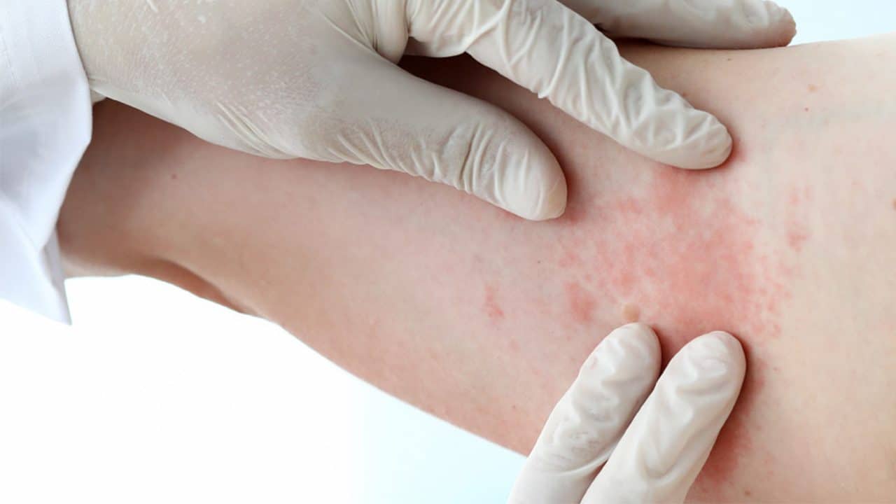 Dermatite atopica avambraccio