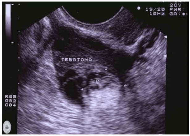 Immagine ecografica di un teratoma immaturo. Teratomi ovarici e cisti dermoidi
