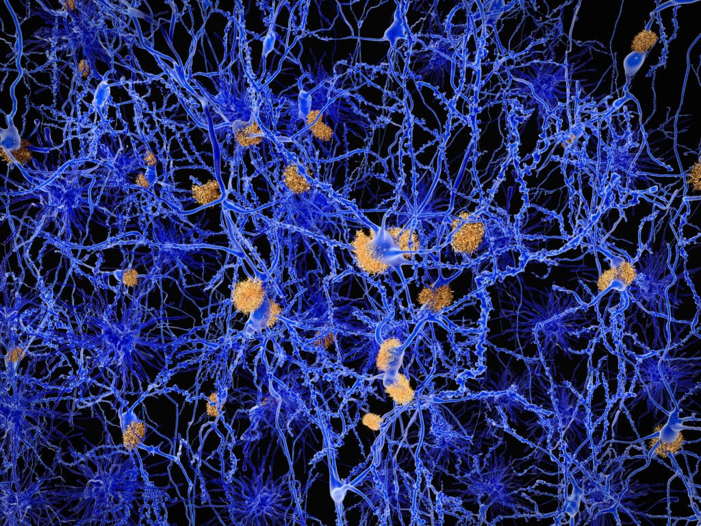 alzheimer risultati clinici