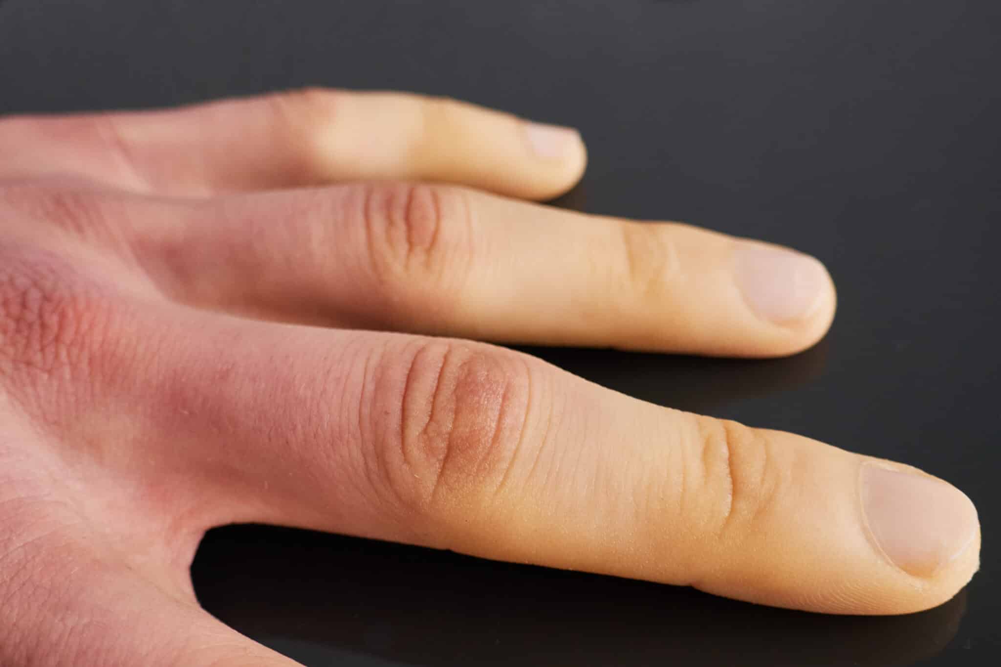 sindrome-di-raynaud-cos-cause-e-trattamenti-cuenews