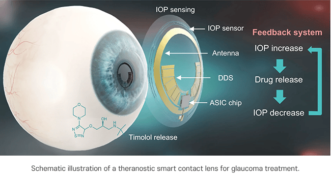 glaucoma lente