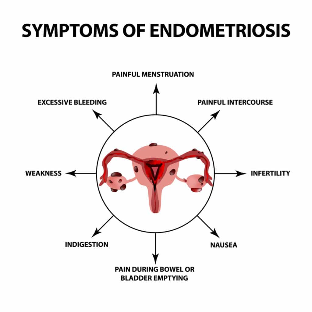 Endometriosi 