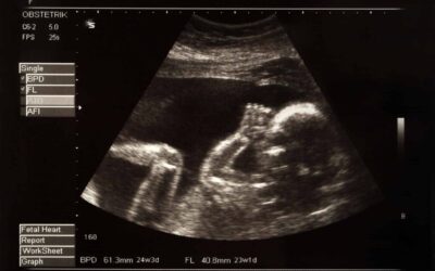 Bambino di pietra: cos’è questa gravidanza extrauterina rara