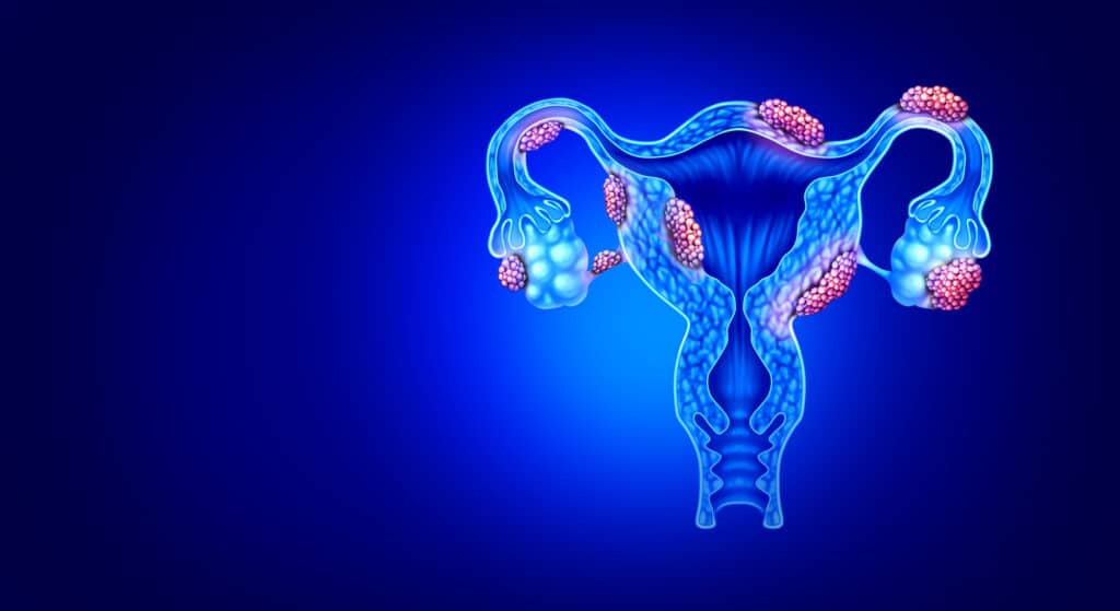 Endometriosi